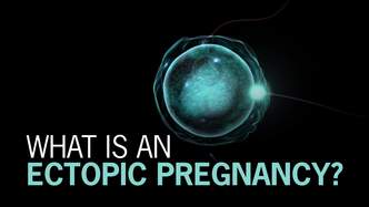 Ectopic Pregnancy Symptoms Causes Treatments Tests