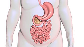Gastric Sleeve Surgery Weight Loss Cleveland Clinic