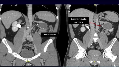 Thumbnail for Robotic Salvage Pyeloplasty with Buccal Mucosal Onlay Graft A Simplified Technique