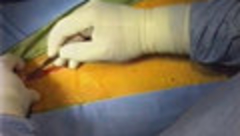 Thumbnail for Aortic Root Remodeling for Bicuspid Aortic Valve