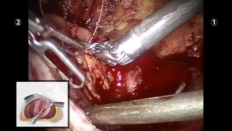 Thumbnail for Robotic Partial Nephrectomy for Tumors that Invade Sinus Fat