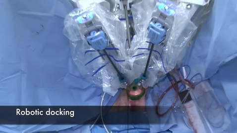 Thumbnail for Robotics and the Perineal Approach to Radical Prostatectomy