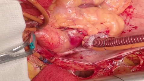 Thumbnail for Reimplantation of the Aortic Valve in a Patient with Loeys-Dietz in the Replacement of the Aortic Root (Long version)
