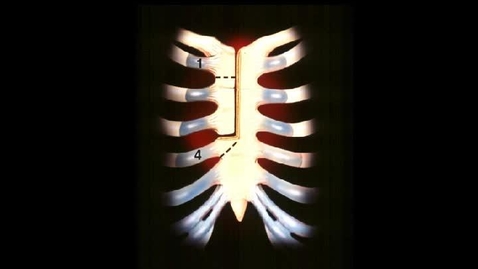 Thumbnail for Minimal J Incision Aortic Valve Replacement with Trifecta Valve