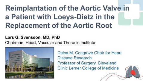 Thumbnail for Reimplantation of the Aortic Valve in a Patient with Loeys-Dietz in the Replacement of the Aortic Root (Short version)