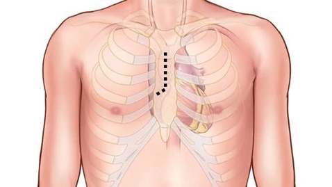 Thumbnail for Aortic Valve Replacement with a Pericardial Tissue Valve - Lars Svensson, MD, PhD