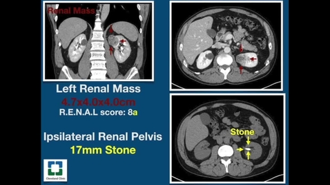 Thumbnail for Concurrent Robotic Partial Nephrectomy and Pyelolithotomy- Tips And Tricks
