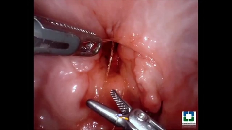 Thumbnail for Robotic Transvesical Part Partial Prostatectomy Using a Purpose-Built Single Port Robotic System