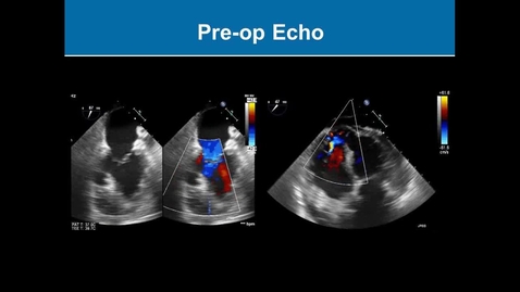 Thumbnail for Post Infarct Ventricular Septal Rupture: Surgical Repair (Graphic)