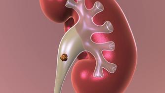 How long does it take to 2024 pass a kidney stone with flomax