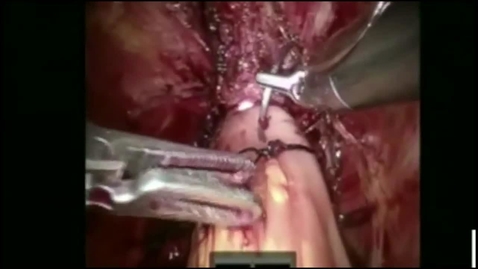 Thumbnail for Robotic-Assisted Radical Cystectomy with Intracorporeal Neobladder Formation