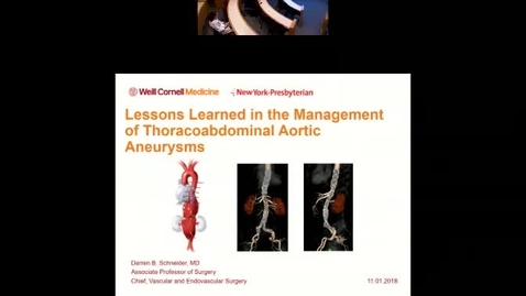 Thumbnail for entry Lessons Learned in the Management of Thoraco-abdominal Aortic Aneurysms
