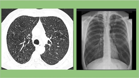 Thumbnail for 5/5/25 Topics in Medicine and Surgery - Presented by Melanie Garcia, APRN - ICU Management of COPD Exacerbation