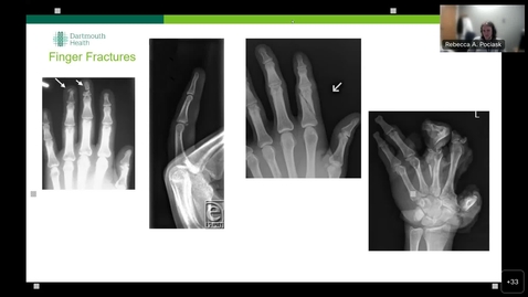 Thumbnail for entry 6/5/23 Topics in Medicine and Surgery - Management of Hand and Wrist Fractures presented by Rebecca Pociask, PA