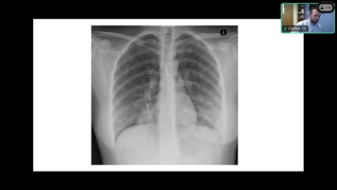 Thumbnail for Topics in Medicine and Surgery - Management of Pneumonia in the ICU - Presented by Carlos Borges, PA-C-