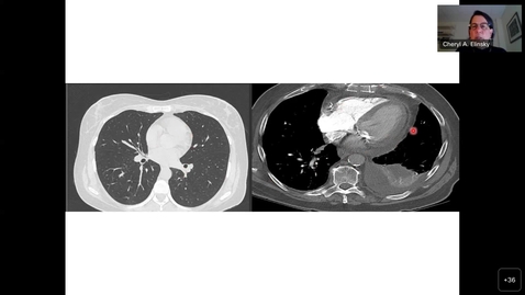 Thumbnail for 4/3/23 Topics in Medicine and Surgery - Complicated Patient with Chest Pains and SOB Presented by Cheryl Elinsky, PA-C