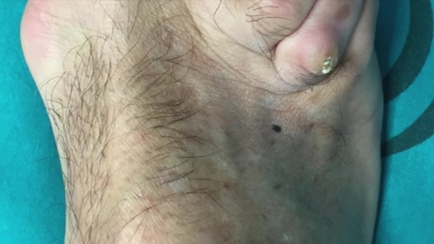Miniatura para CIRUGÍA ORTOPÉDICA. MI. Cirugia Antepie Osteotomías
