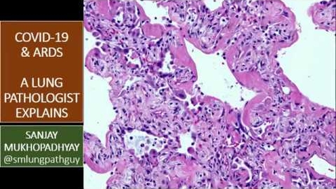 Thumbnail for A Pulmonary Pathologist's Perspective on COVID-19