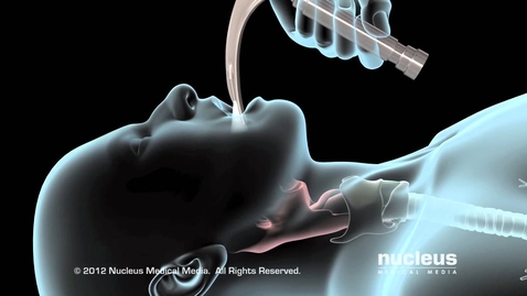 Thumbnail for entry Intubation and Mechanical Ventilation