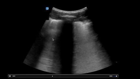 Thumbnail for entry POCUS - COVID Lung Ultrasound