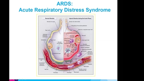 Thumbnail for Overview of Critical Care Management of COVID Patients in the ICU by Dr. Bassily-Marcus, MD