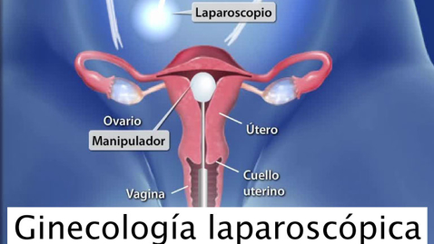 Miniatura para Ginecología laparoscópica