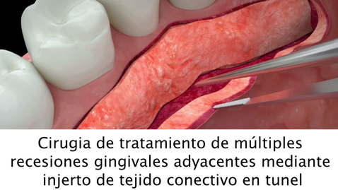 Miniatura para Cirugia de tratamiento de múltiples recesiones gingivales adyacentes mediante injerto de tejido conectivo en tunel