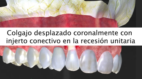 Miniatura para Colgajo desplazado coronalmente con injerto conectivo en la recesión unitaria