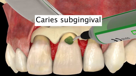 Miniatura para Caries subgingival