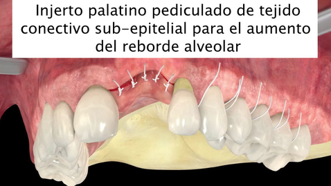 Miniatura para Injerto palatino pediculado de tejido conectivo sub-epitelial para el aumento del reborde alveolar