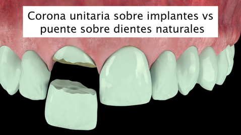 Miniatura para Corona unitaria sobre implantes vs puente sobre dientes naturales