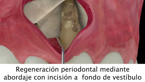 Miniatura para Regeneración periodontal mediante abordaje con incisión a  fondo de vestíbulo