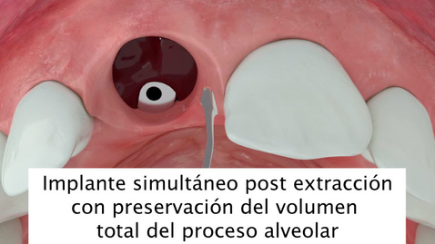 Miniatura para Implante simultáneo post extracción con preservación del volumen total del proceso alveolar