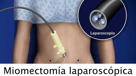 Miniatura para Miomectomía laparoscópica