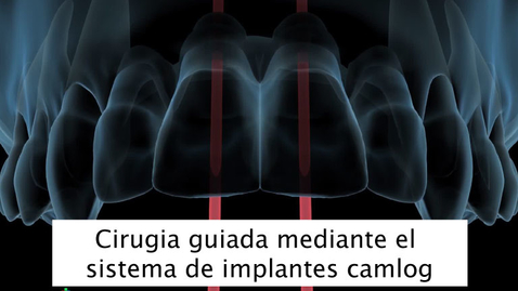 Miniatura para Cirugia guiada mediante el sistema de implantes camlog