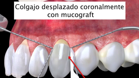 Miniatura para Colgajo desplazado coronalmente con mucograft