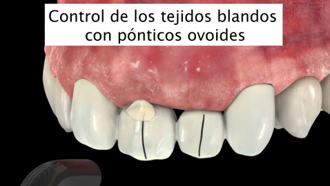 Miniatura para Control de los tejidos blandos con pónticos ovoides