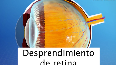 Miniatura para Desprendimiento de retina