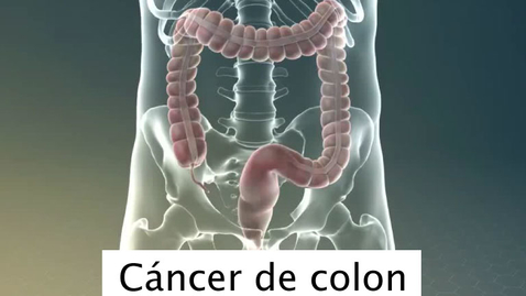 Miniatura para Cáncer de Colon
