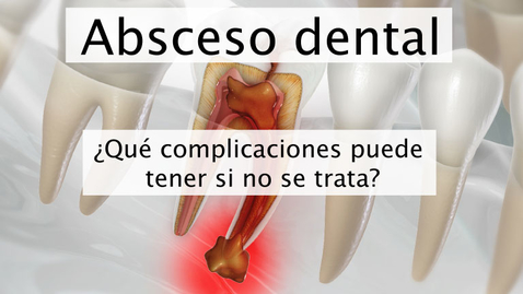 Miniatura para Absceso dental
