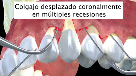 Miniatura para Colgajo desplazado coronalmente en múltiples recesiones