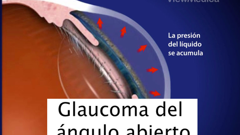 Miniatura para Glaucoma del ángulo abierto