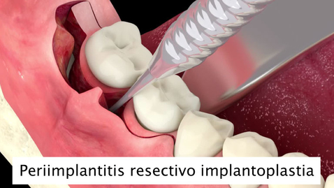 Miniatura para Periimplantitis resectivo implantoplastia