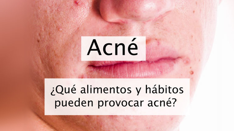 Miniatura para Acné