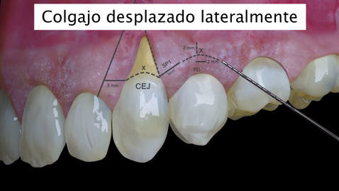 Miniatura para Colgajo desplazado lateralmente