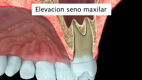 Miniatura para Elevacion seno maxilar