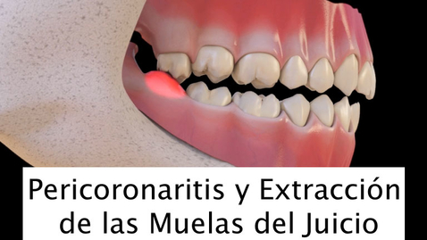 Miniatura para Pericoronaritis y Extracción de las Muelas del Juicio