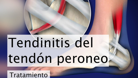 Miniatura para Tendinitis del tendón peroneo