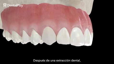 Miniatura para Injerto de Hueso en Bloque