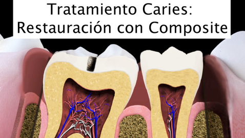 Miniatura para Tratamiento Caries: Restauración con Composite